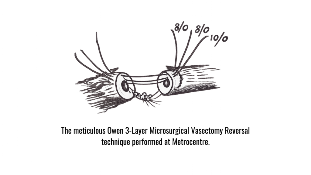 The meticulous Owen 3-Layer Microsurgical Vasectomy Reversal technique performed at Metrocentre.